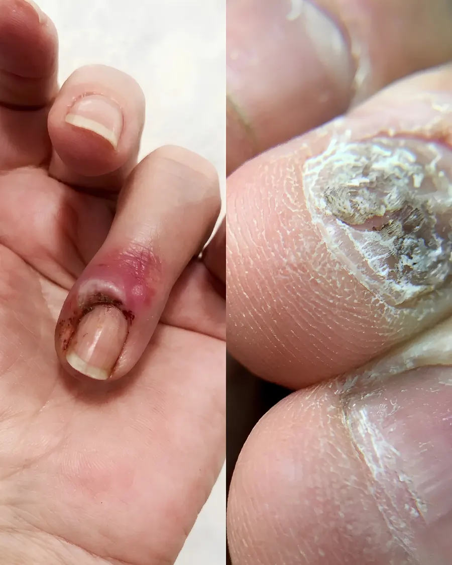 Nail Disorder at Cinch Clinics